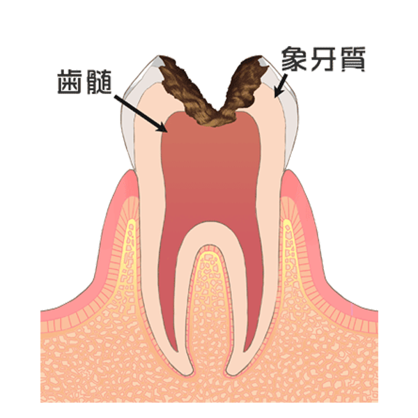 神経まで達した虫歯