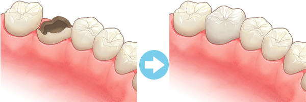クラウン（被せ物）