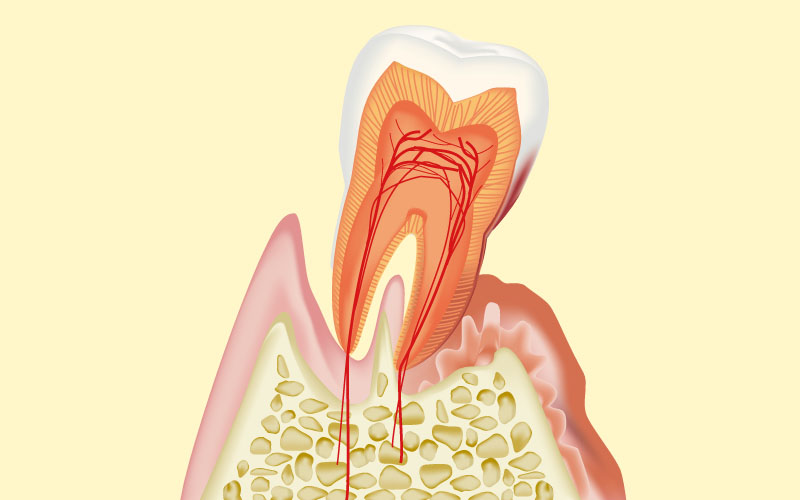 歯周病治療